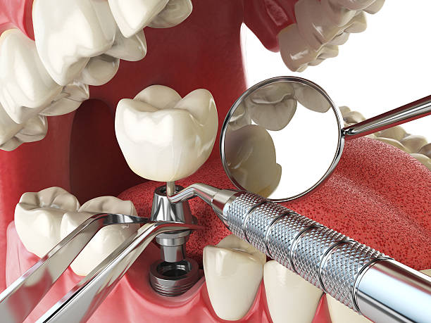 Best Emergency Tooth Extraction in Riverside, MO